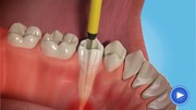 NHs Root Canal Treatment Cost
